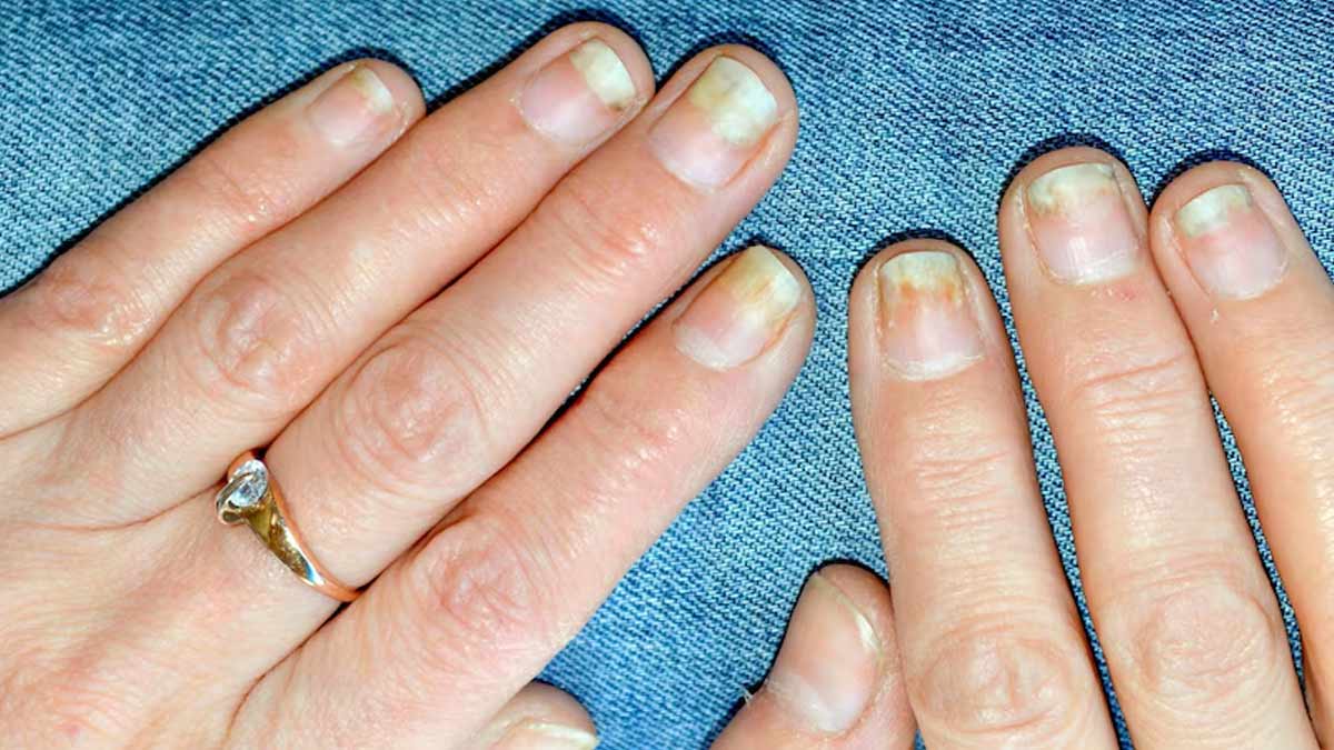 Nail Psoriasis: Symptoms To Help Distinguish It From Nail Fungus