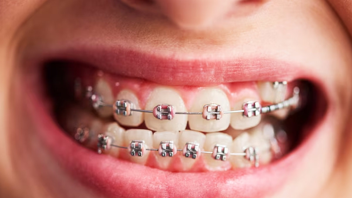 How To Properly Care For Your Braces