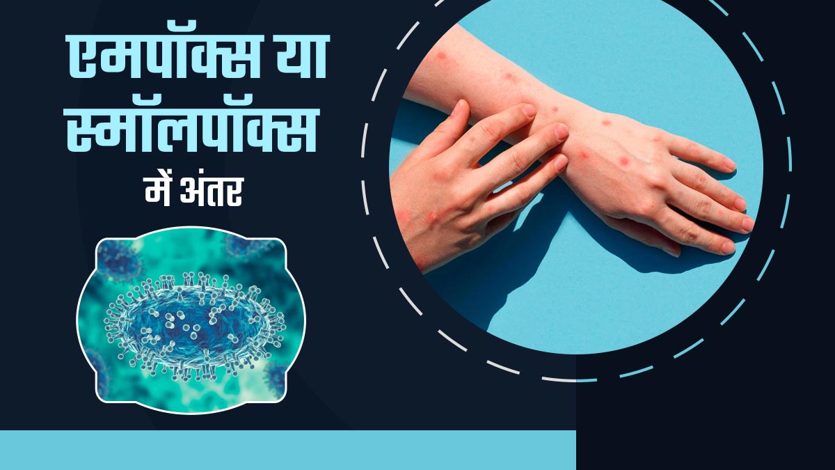 Mpox vs Smallpox: लगभग एक जैसे दिखते हैं एमपॉक्स और स्मॉल पॉक्स के लक्षण, जानें दोनों में अंतर