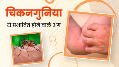 चिकनगुनिया से कौन-से अंग प्रभावित हो सकते हैं? डॉक्टर से जानें