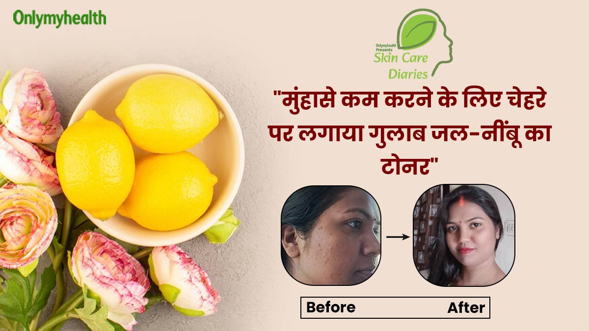 नींबू के रस और गुलाबजल से बिंदू को मिला मुंहासों से छुटकारा, जानें किस स्किन टाइप के लिए फायदेमंद है यह मिश्रण