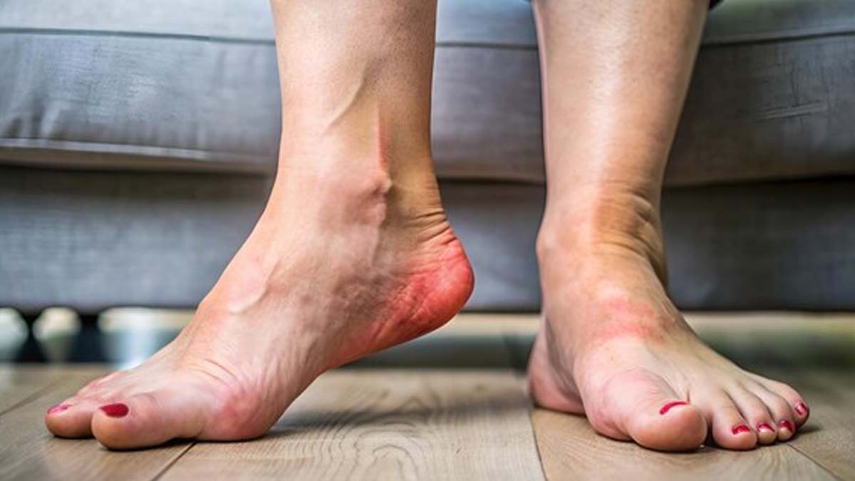 Types Of Gangrene In Hindi