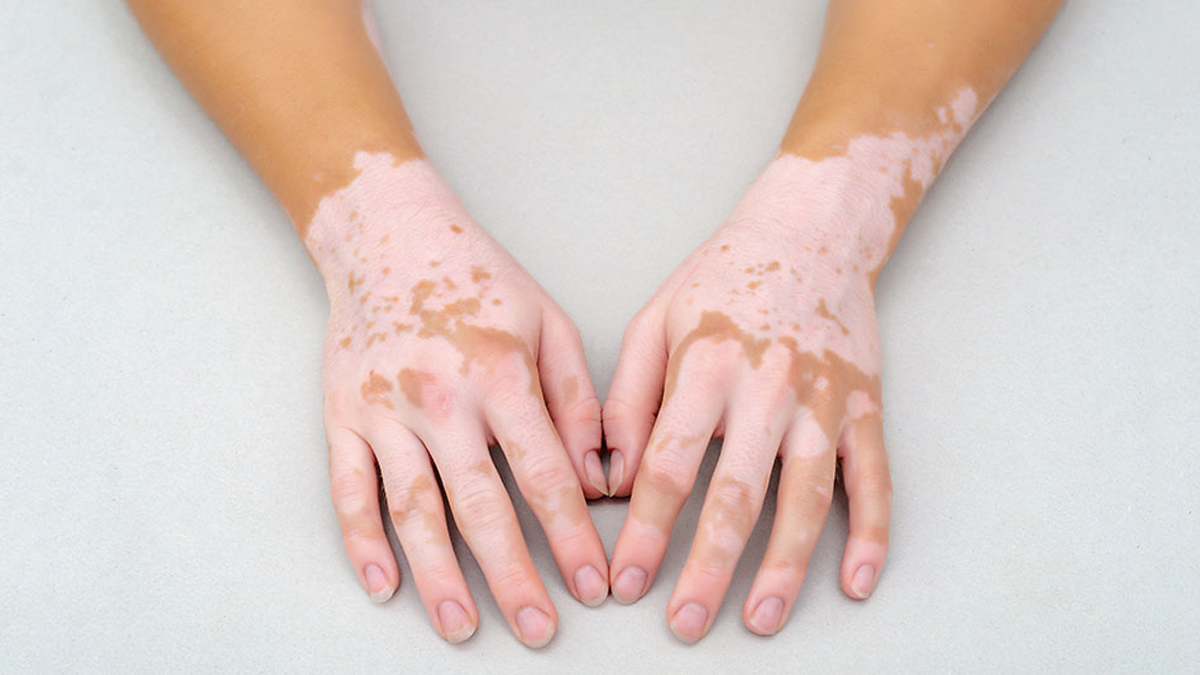 Vitiligo