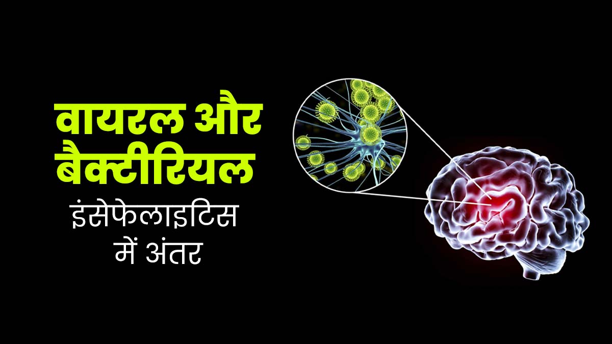 वायरस और बैक्‍टीर‍िया की वजह से हो सकती है दिमाग में सूजन, जानें वायरल और बैक्टीरियल इंसेफेलाइटिस में अंतर