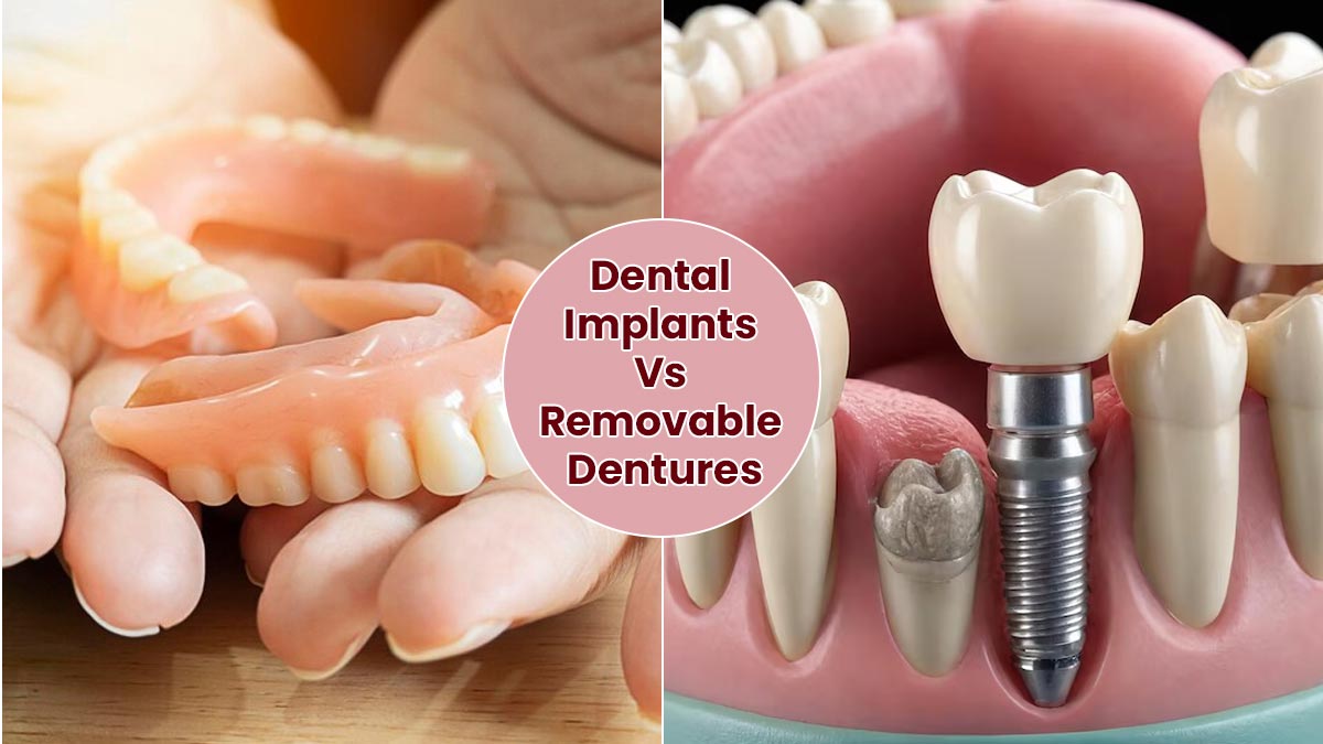 Fixed Dental Implants Vs Removable Dentures: Which Tooth Replacement Option Is Right for You?