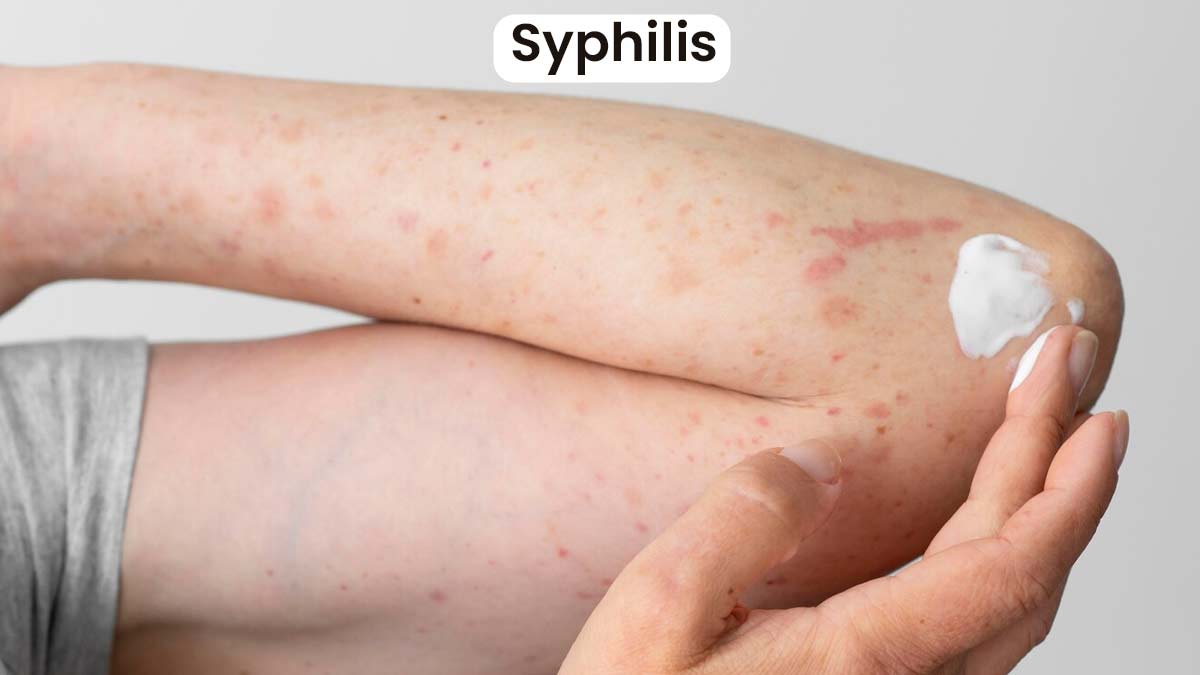 syphlis