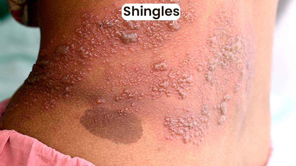 monkeypox and other skin conditions 