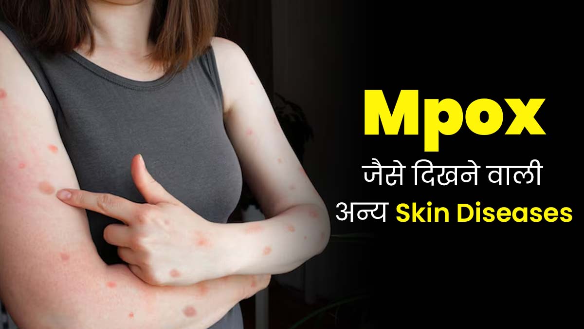 एक जैसे दिख सकते हैं Mpox और इन 3 स्किन इंफेक्शन की वजह से होने वाले रैशेज, ऐसे पहचानें अंतर 