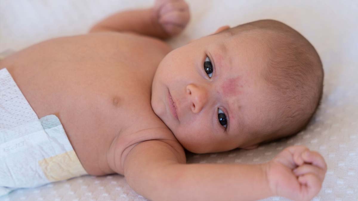 monkeypox in pregnancy