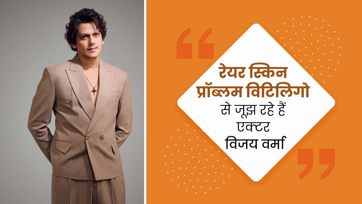 सफेद दाग की समस्या (विटिलिगो) से जूझ रहे हैं एक्टर विजय वर्मा, जानें इस बीमारी का इलाज संभव है या नहीं?