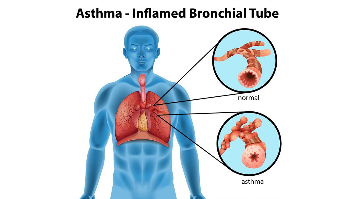 Tips To Control Asthma During pollution Winter In Hindi