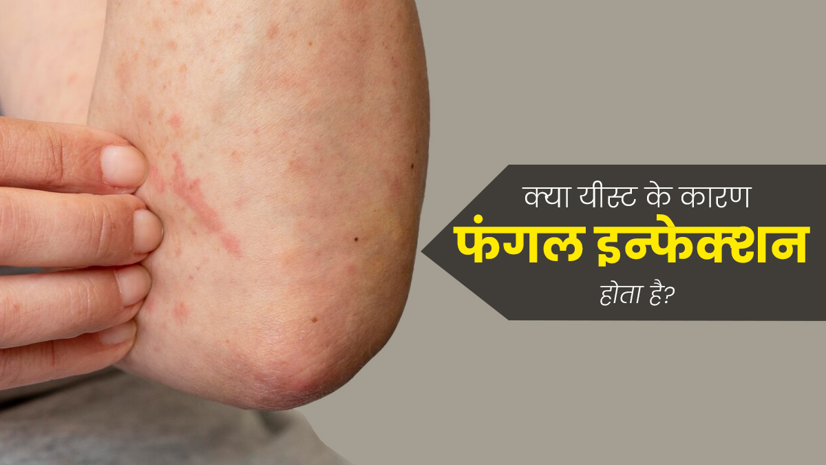 क्‍या यीस्‍ट के कारण फंगल इन्‍फेक्‍शन होता है? डॉक्‍टर से जानें 