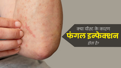 क्‍या यीस्‍ट के कारण फंगल इन्‍फेक्‍शन होता है? डॉक्‍टर से जानें 