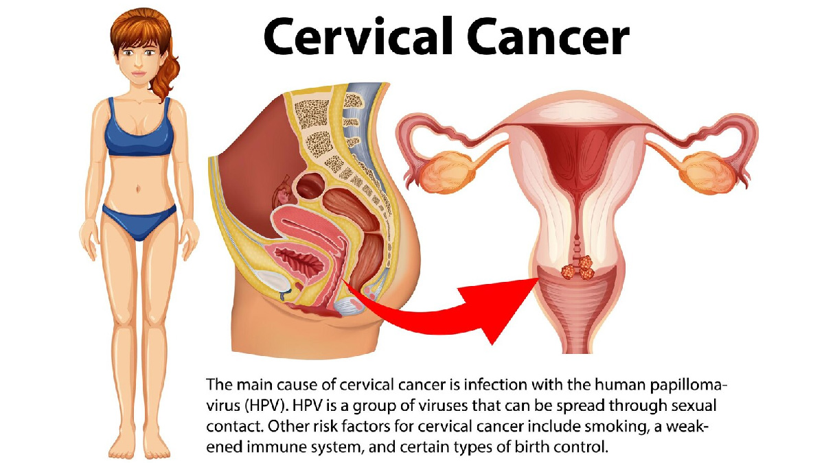 cancer