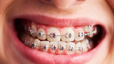 दांतों में ब्रेसेस लगवाने के बाद क्‍या खाना चाह‍िए? एक्‍सपर्ट से जानें 