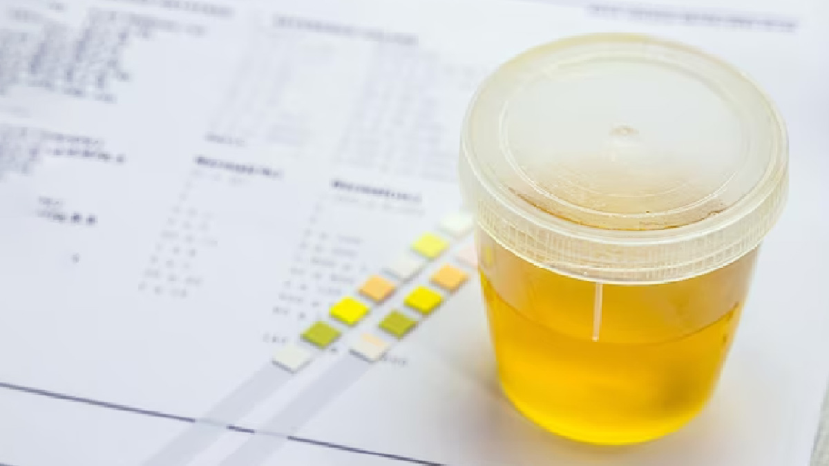 Dealing With High Uric Acid Levels? Avoid These Five Pulses To Lower Your Risk Of Gout And Kidney Stones