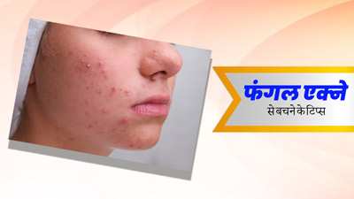 फंगल एक्‍ने होने पर परेशान करते हैं खुजली वाले दाने, जानें कैसे करें बचाव