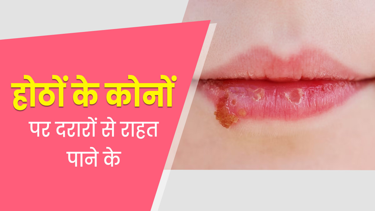 Angular Cheilitis : होंठों के कोनों पर दरार क्यों पड़ जाती है? जानें इसके कारण और घरेलू उपाय