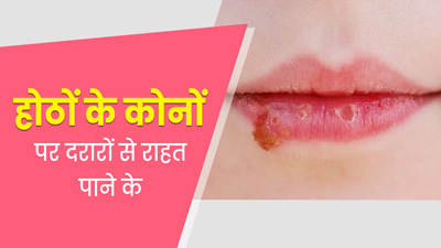 Angular Cheilitis : होंठों के कोनों पर दरार क्यों पड़ जाती है? जानें इसके कारण और घरेलू उपाय