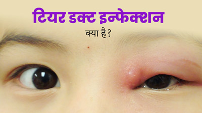 ट‍ियर डक्ट इन्‍फेक्‍शन (डैक्रियोसिस्टाइटिस) क्‍या होता है? जानें इसके लक्षण और इलाज 