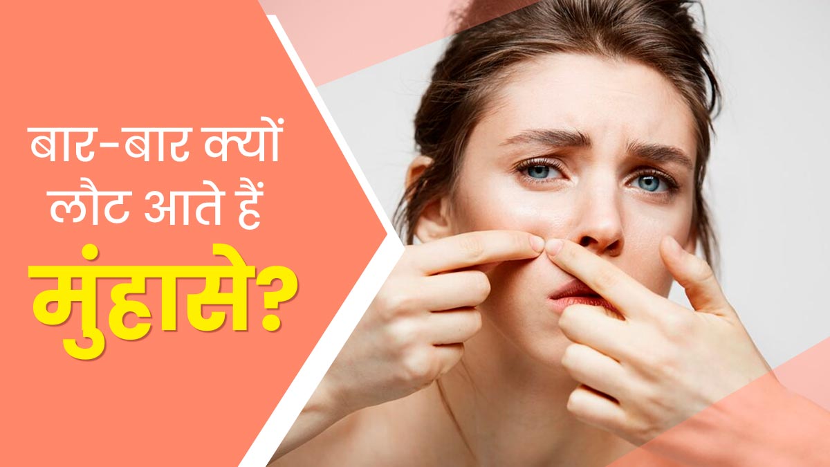 बार-बार लौट आते हैं मुंहासे? लाइफस्‍टाइल से जुड़ी ये 5 खराब आदतें हो सकती हैं जिम्मेदार 