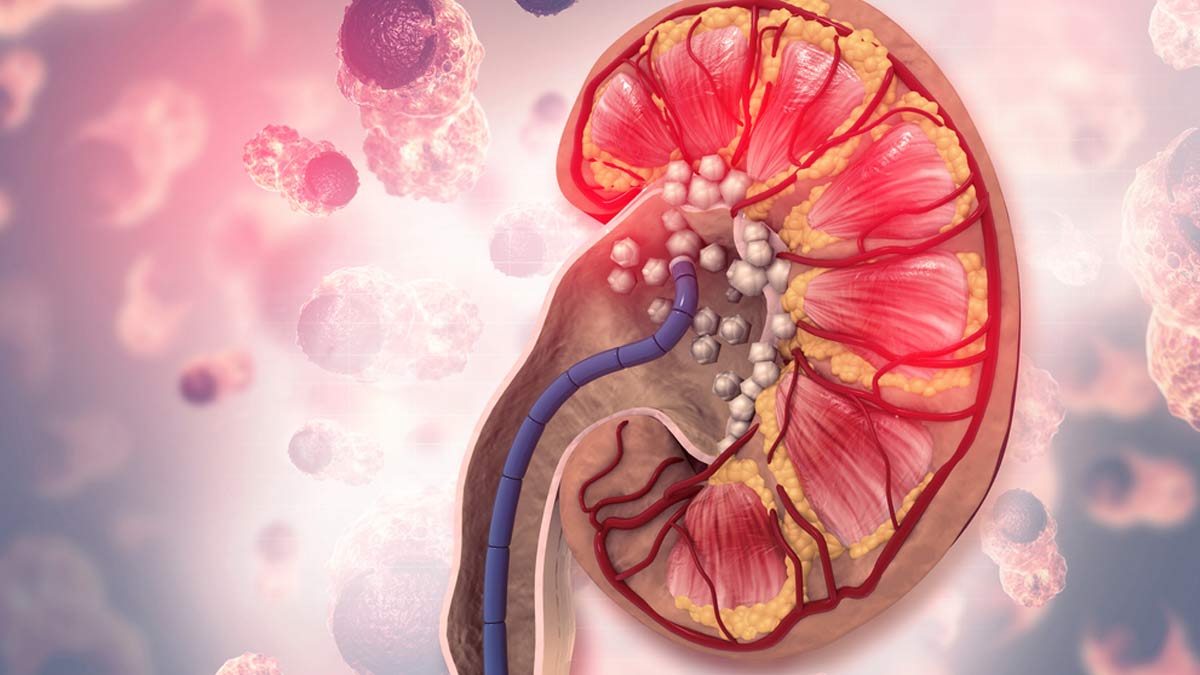 Kidney Stones: Expert Debunks Myths And States Facts About This Condition