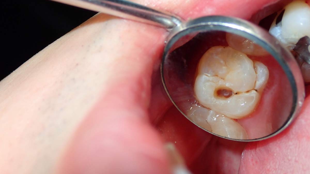 Oral Cavities: Here Are 7 Effective Ways To Prevent Oral Cavities At Home Without Medication