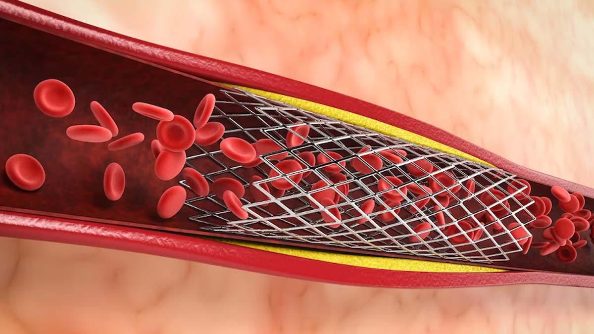 High Cholesterol: Know What Causes Plaque Buildup In Your Arteries?