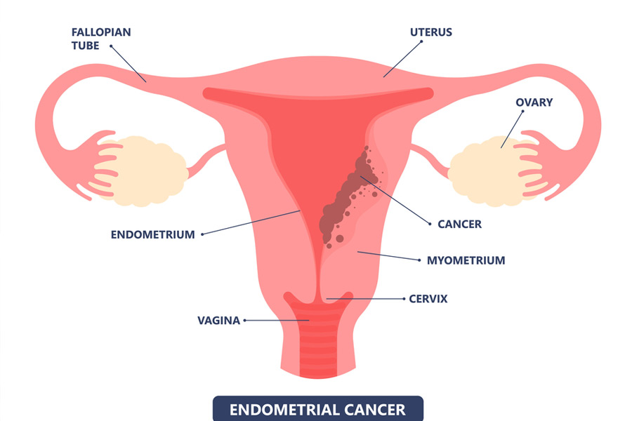 endomentrial-cancer