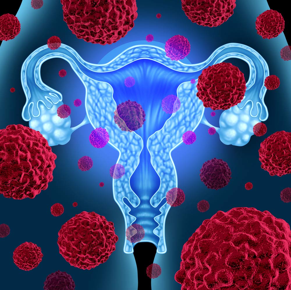 ovarian-cancer