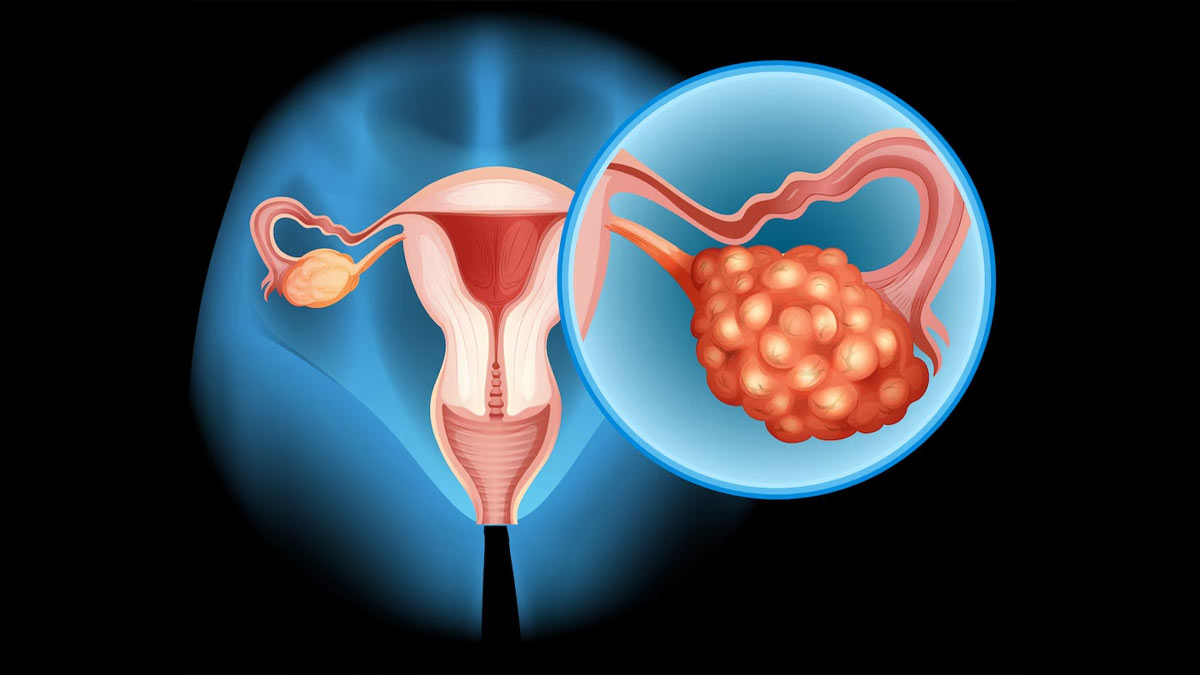 Healthy Habits For PCOS In Hindi