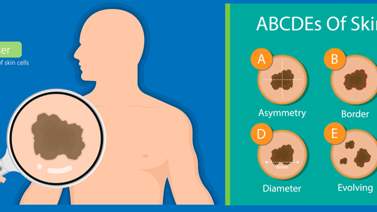 From Changing Moles To Scaly Lesions: Expert Lists Early Signs Of Skin ...