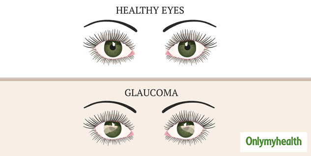 Understanding Dos and Donts of Glaucoma