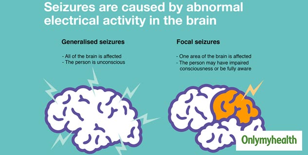 International Epilepsy Day 2024 Essential Facts You Should Know About Epilepsy and Seizures