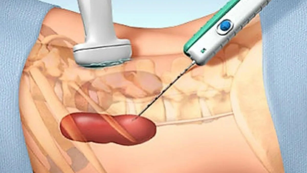 kidney biopsy
