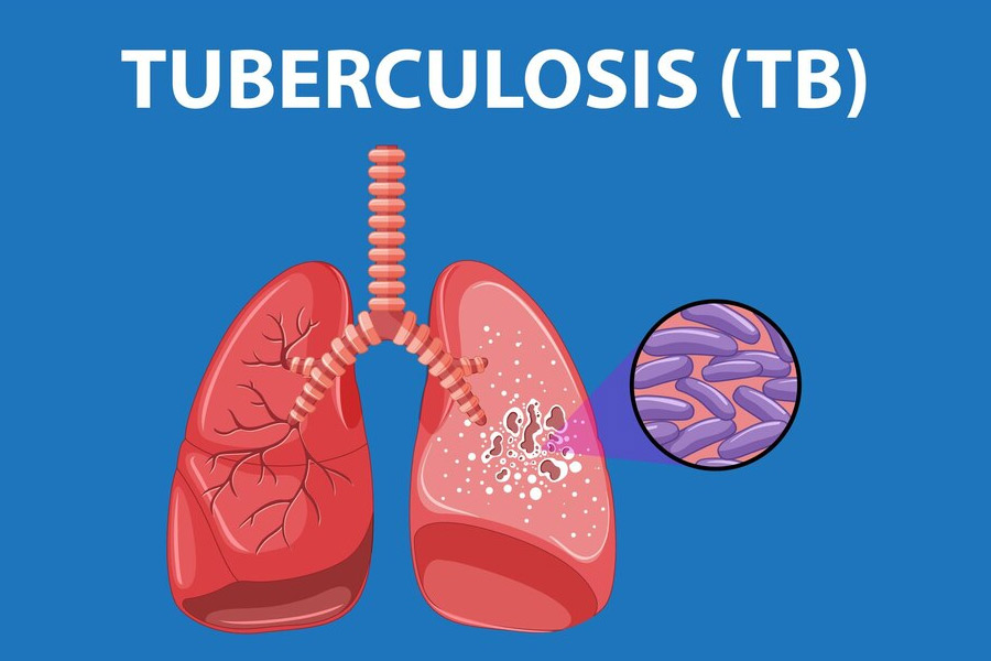 tuberculosis