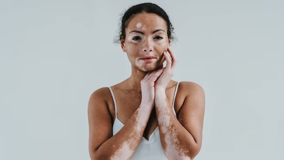 vitiligo