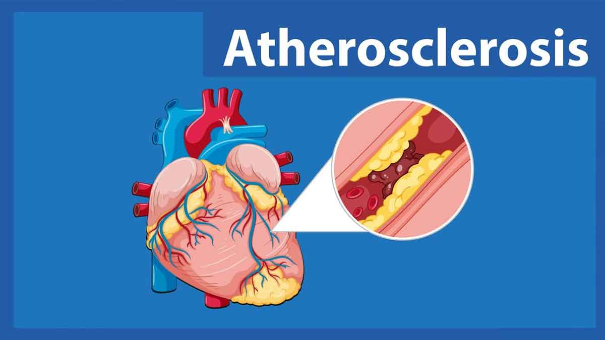 Atherosclerosis: Expert Explains This Silent Threat Lurking In Your Arteries