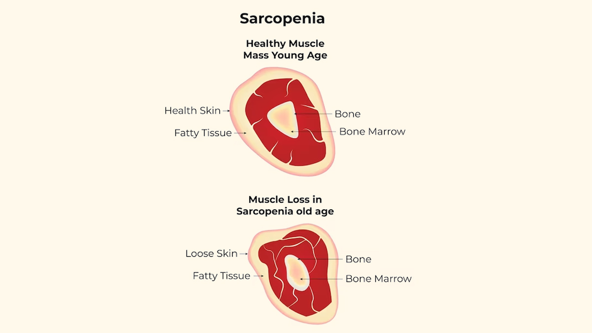 sarcopenia symptoms