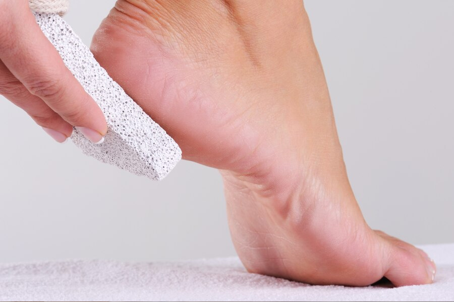dead skin home remedies