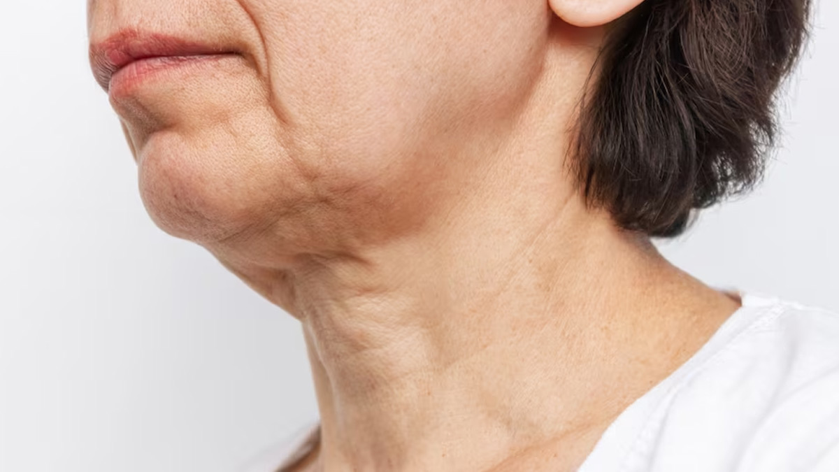 sagging-neck