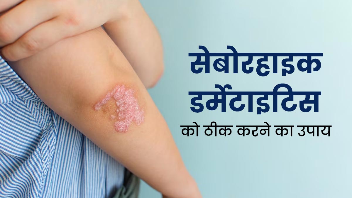 सेबोरिक डर्मेटाइटिस के कारण त्वचा पर बन जाती है सफेद या पीले रंग की पपड़ी, जानें इसे ठीक करने के तरीके
