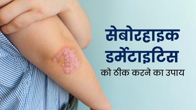 सेबोरिक डर्मेटाइटिस के कारण त्वचा पर बन जाती है सफेद या पीले रंग की पपड़ी, जानें इसे ठीक करने के तरीके
