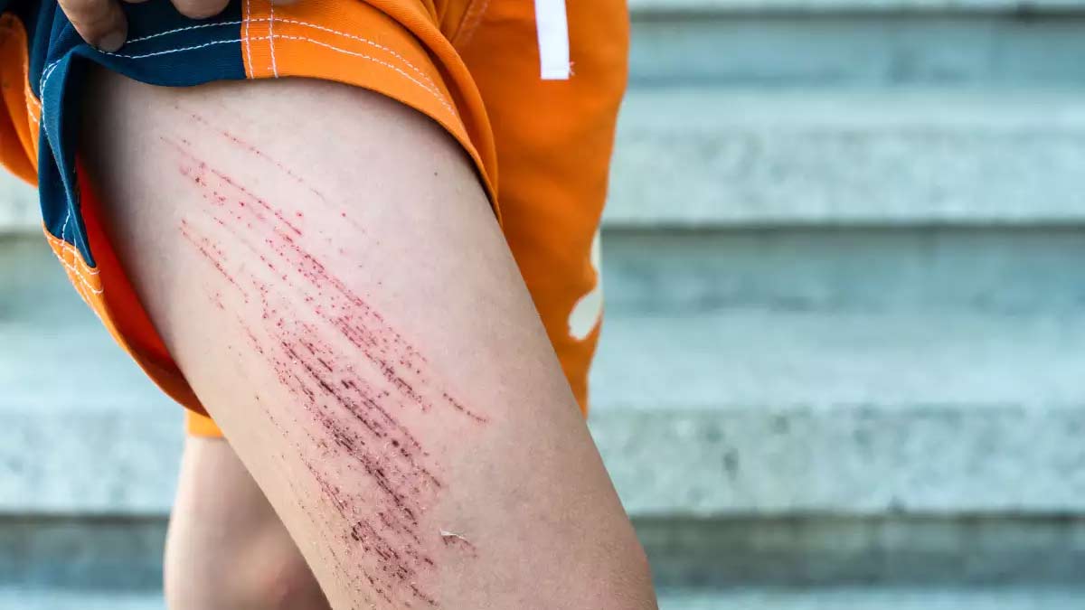 Expert Shares Consequences Of Not Treating Sepsis On Time