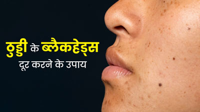 ठुड्डी पर ब्‍लैकहेड्स हो गए हैं, तो छुटकारा पाने के लिए अपनाएं ये 5 उपाय