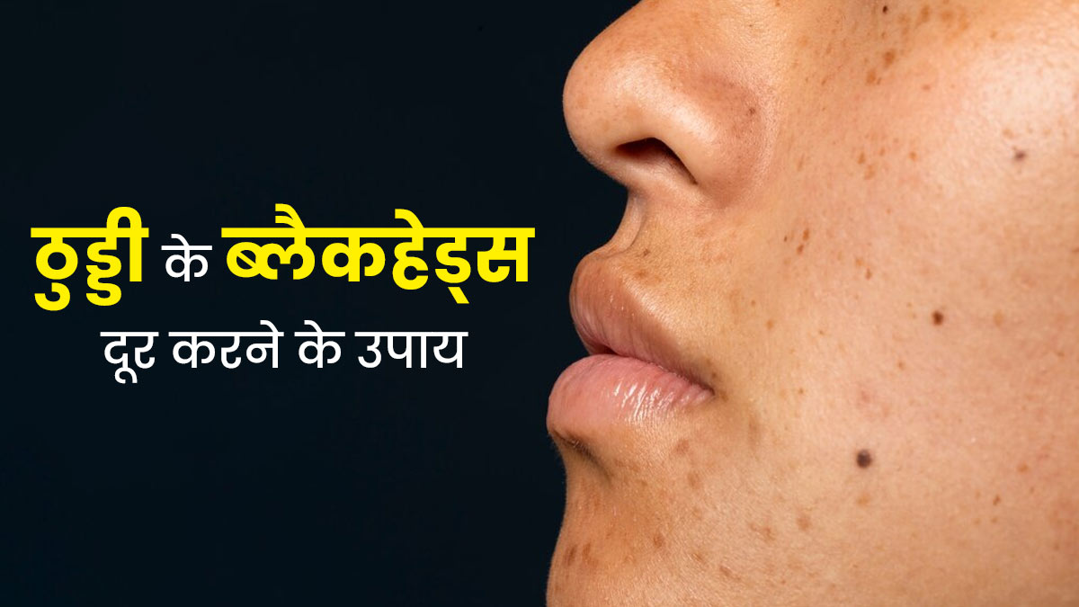 ठुड्डी पर ब्‍लैकहेड्स हो गए हैं, तो छुटकारा पाने के लिए अपनाएं ये 5 उपाय