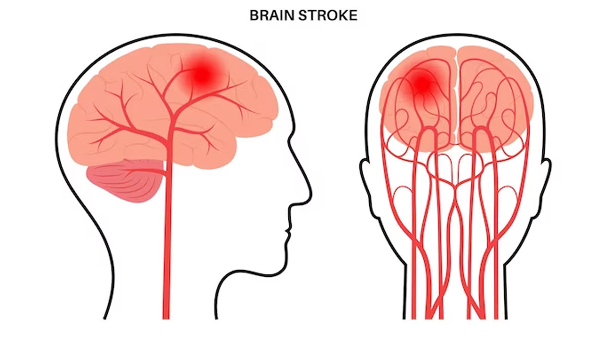 What Are The Warning Signs Seven Days Before A Stroke In Hindi