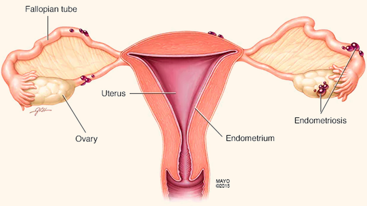 Endometriosis