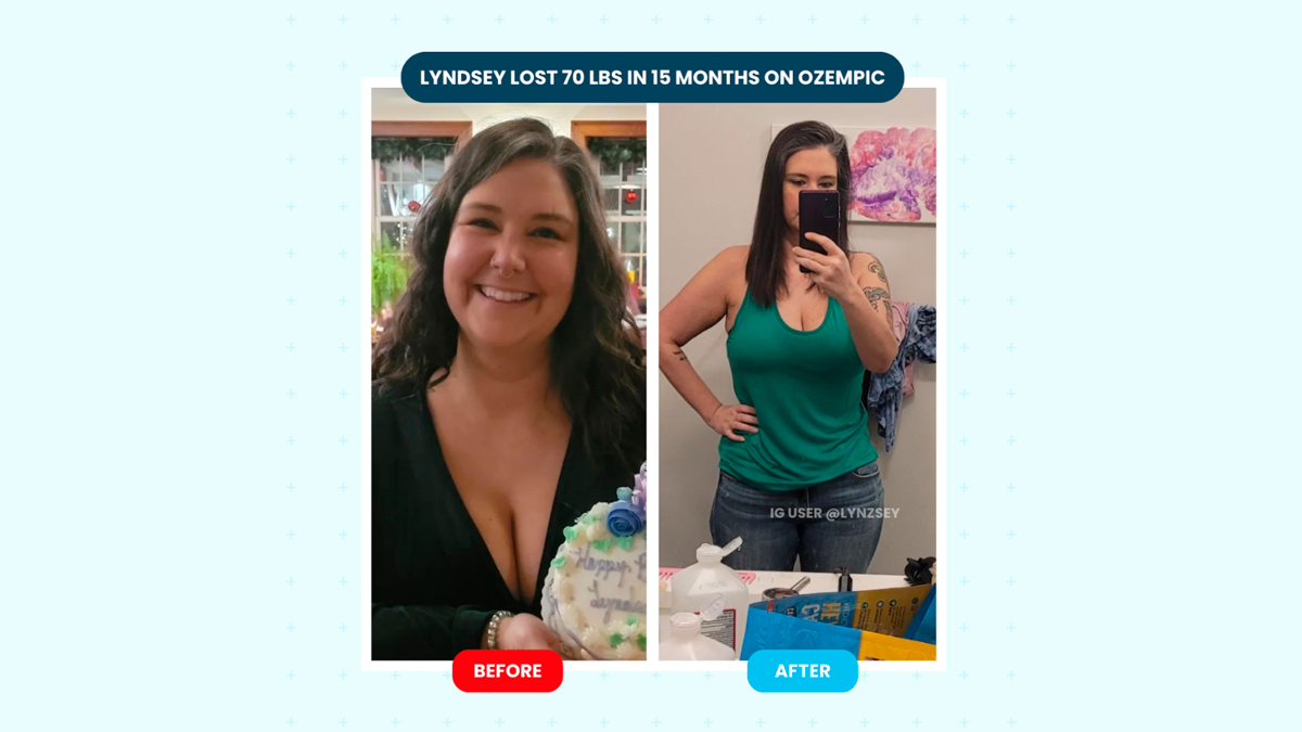 Ozempic Weight Loss Reviews — Before and After Photos OnlyMyHealth