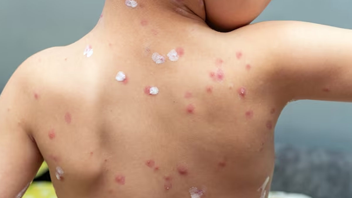 Measles-Cases-in-MP-ins
